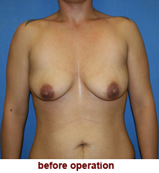 plastic-surgery-breast-lift-augmentation